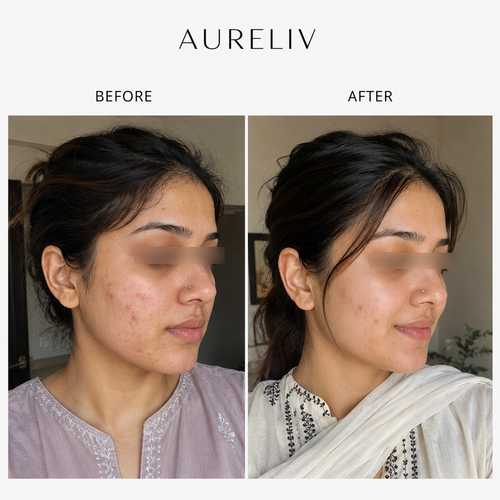 3 Weeks Acne Reduction